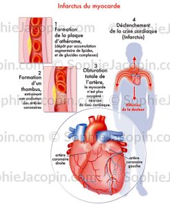 INFARCTUS DU MYOCARDE