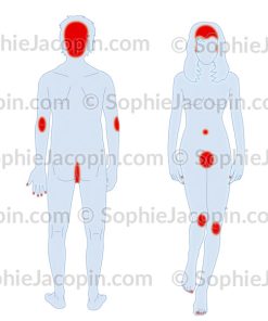 ZONES LOCALISATION PSORIASIS